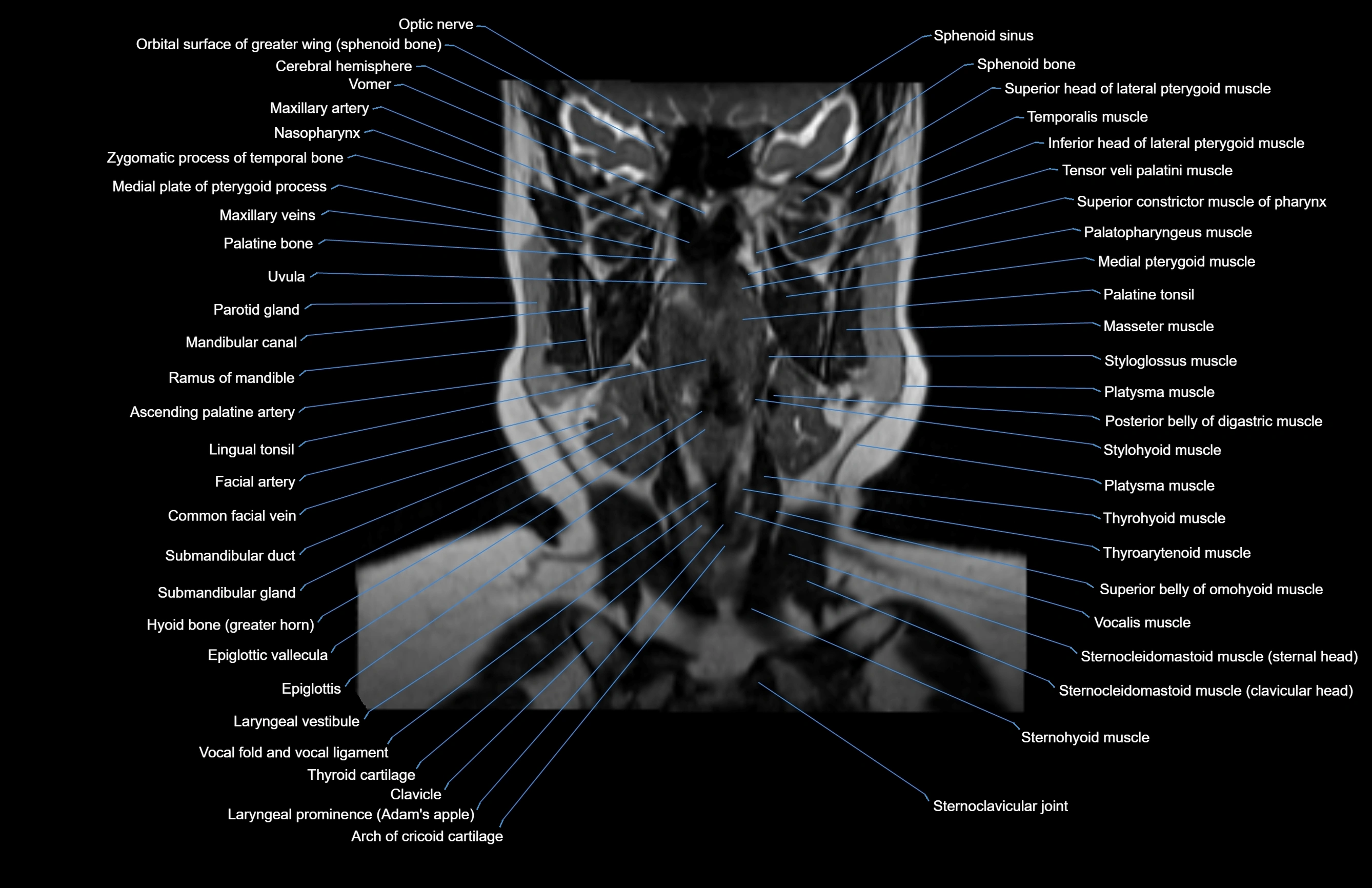 Neck coronal cross sectional MRI anatomy 3T MRI  image-img-00001-00047.webp
